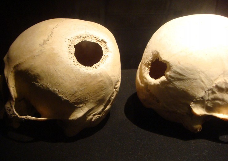 На черепе древнего человека видны следы трепанации