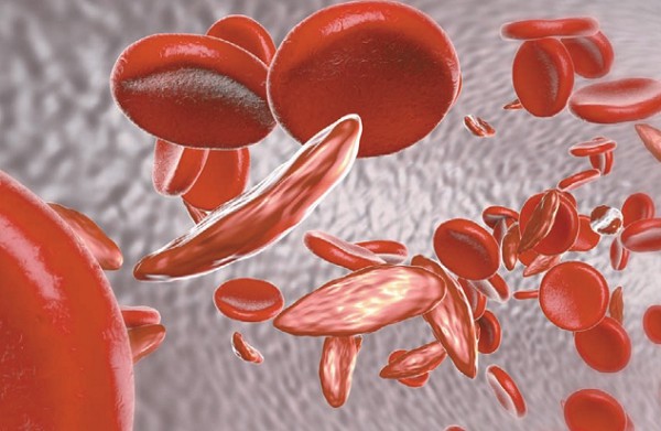 Нормальные и мутировавшие эритроциты при серповидноклеточной анемии