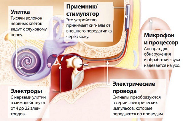 Кохлеарный имплантат Nucleus 6 компании Cochlear