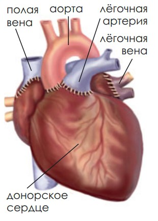 Размещение донорского сердца в грудной клетке, швы, соединяющие сосуды