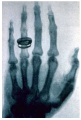 Первый рентгеновский снимок (рентгенограмма), сделанный В.К. Рентгеном в 1895 г.