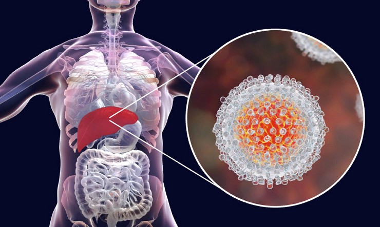 Вирусы гепатитов В и С широко распространены среди людей, живущих с ВИЧ